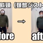 痙性斜頸　勝手に上を向く　ジストニア